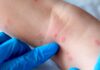 Vaiolo delle scimmie, nelle Marche a breve i vaccini